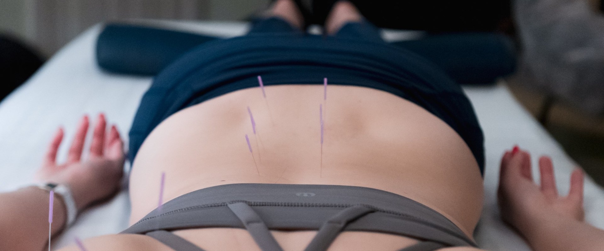 5 Tips for Finding a Reputable Acupuncturist