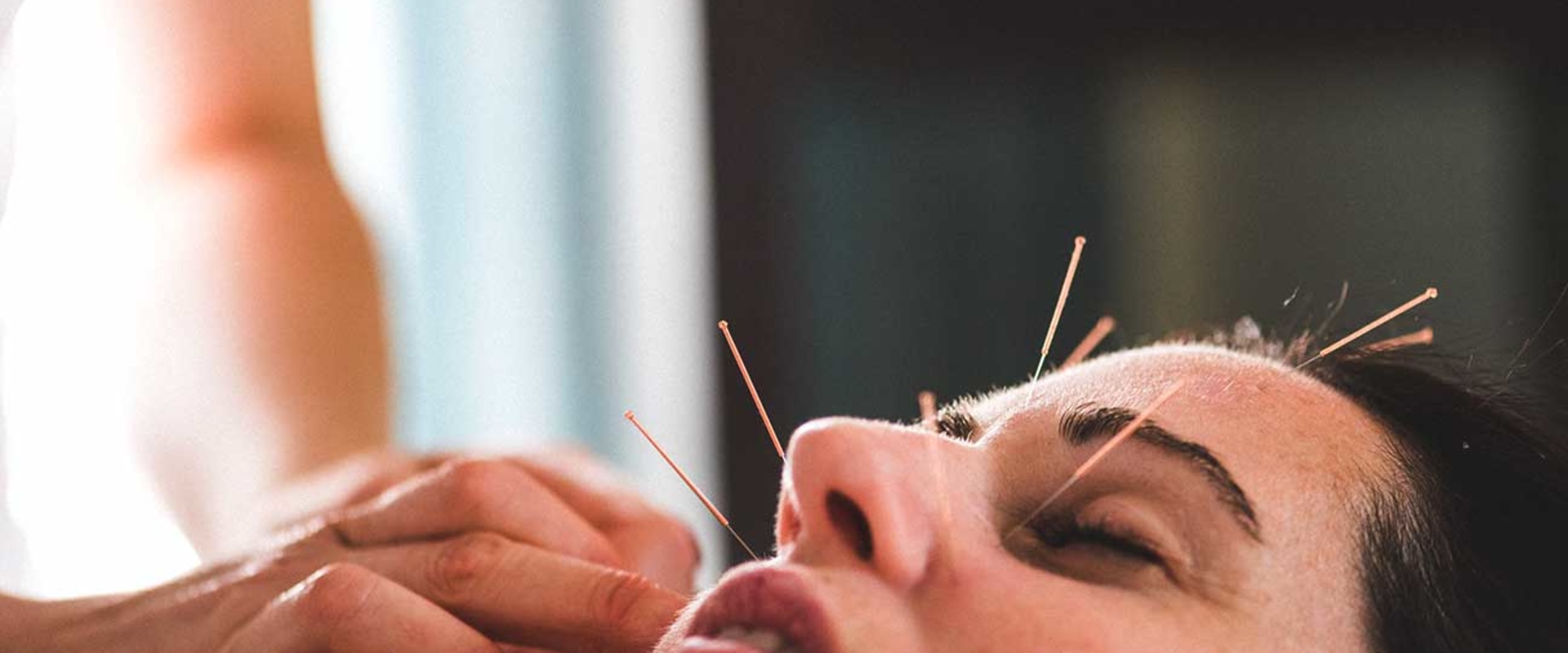 How Acupuncture Can Improve Your Health and Beauty