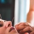 How Acupuncture Can Improve Your Health and Beauty