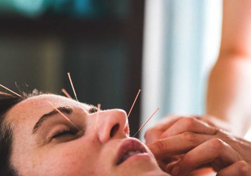 How Acupuncture Can Improve Your Health and Beauty